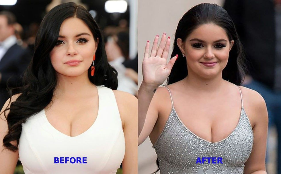 Why More Stars Are Choosing Breast Reductions